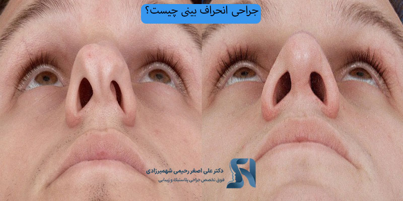 جراحی-انحراف-بینی