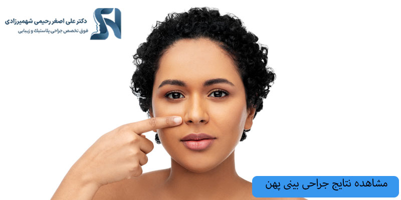 نتایج-جراحی-بینی-پهن