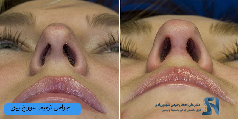 جراحی-ترمیم سوراخ بینی