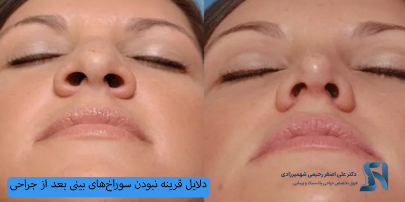 دلایل قرینه نبودن سوراخ‌های بینی بعد از جراحی