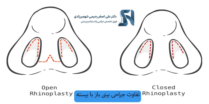تفاوت-جراحی-بینی