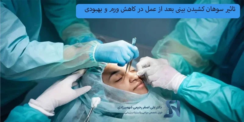 تاثیر-سوهان-کشیدن-بینی-بعد-از-عمل-در-کاهش-ورم-و-بهبودی