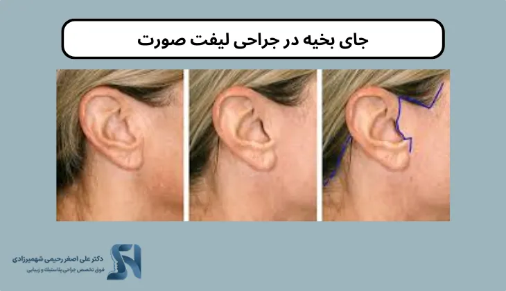جای بخیه در جراحی لیفت صورت