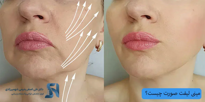 مینی-لیفت-صورت-چیست؟