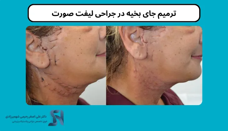 نحوه ترمیم جای بخیه در جراحی لیفت صورت