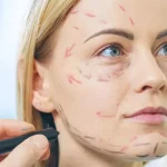ورم بعد از جراحی لیفت صورت