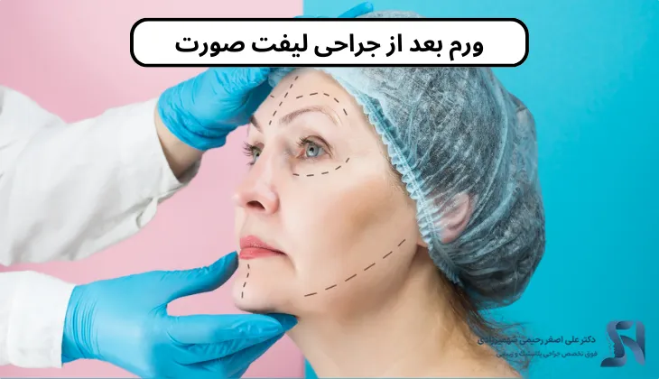 ورم بعد از جراحی لیفت صورت