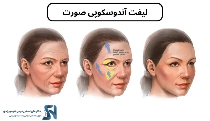 لیفت آندوسکوپی صورت