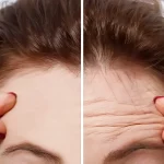 عمل لیفت شقیقه