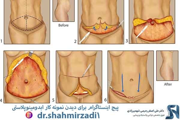جراحی ابدومینوپلاستی
