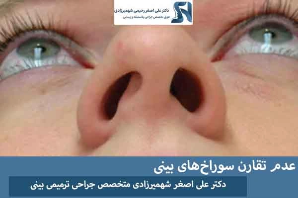 عدم تقارن سوراخ های بینی
