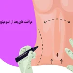 مراقبت‌های بعد از ابدومینوپلاستی