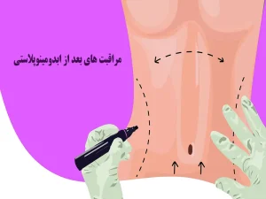 مراقبت‌های بعد از ابدومینوپلاستی