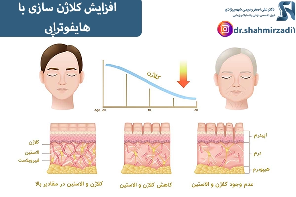 افزایش کلاژن سازی با هایفوتراپی